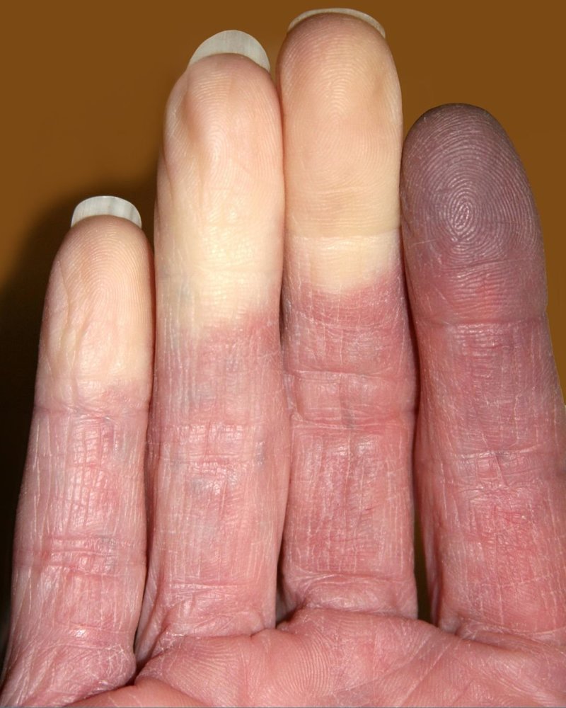 Supporting image for Coffee Break February:  Let’s Talk about the “Cold” hard facts of living with Raynaud’s Phenomenon & how Stopping Smoking can help 